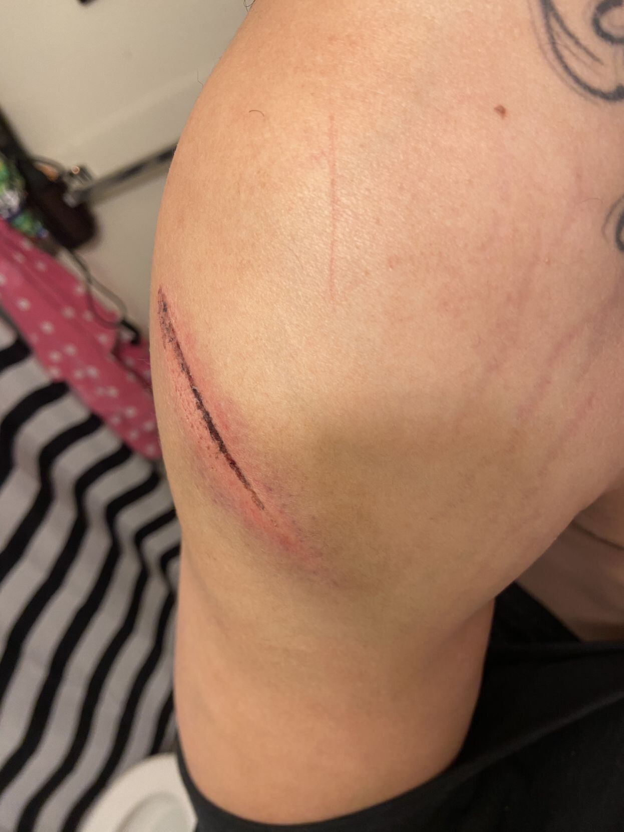 Shoulder Laceration.JPG